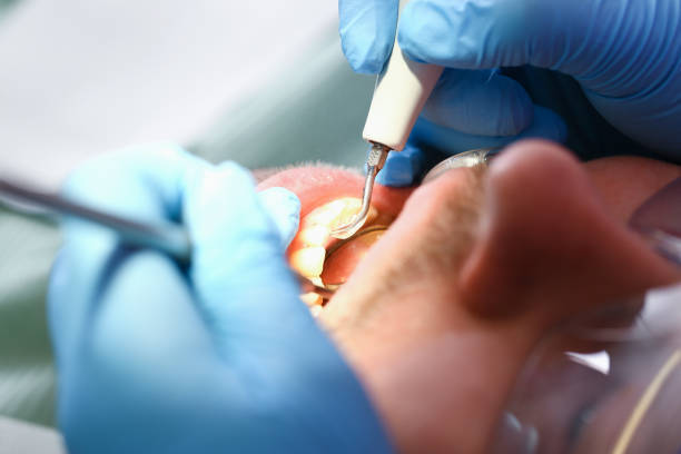 Best Dentist for Tooth Abscess  in Taft, TX